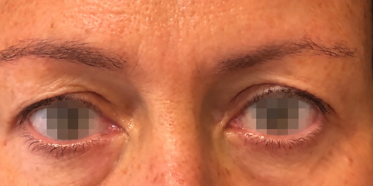 Blefaroplastica, caso clinico 2 — sguardo prima dell'intervento