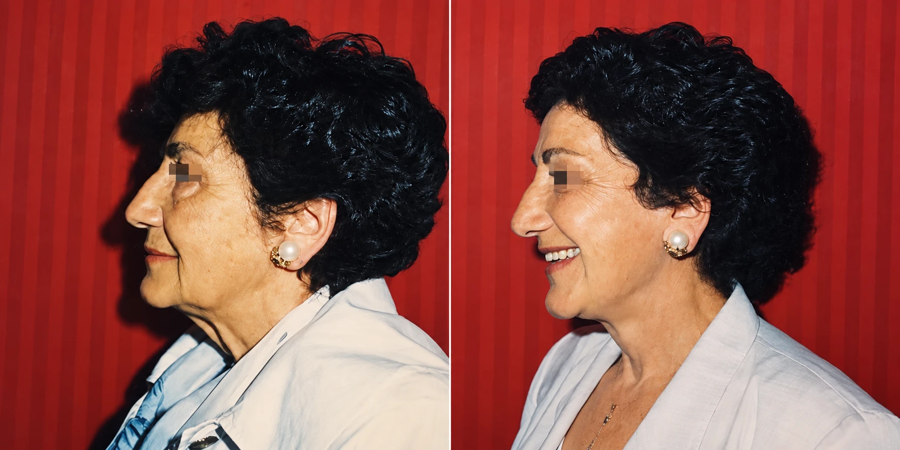 Lifting facciale, caso clinico 1 — a sinistra prima dell'intervento, a destra dopo l'intervento